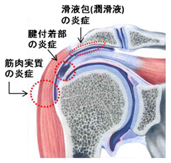 肩関節周囲炎 ふなせいトピックス 船橋整形外科 市川クリニック Funabashi Orthopedic Ichikawa Clinic 肩関節周囲炎 ふなせいトピックス 船橋整形外科 市川クリニック Funabashi Orthopedic Ichikawa Clinic