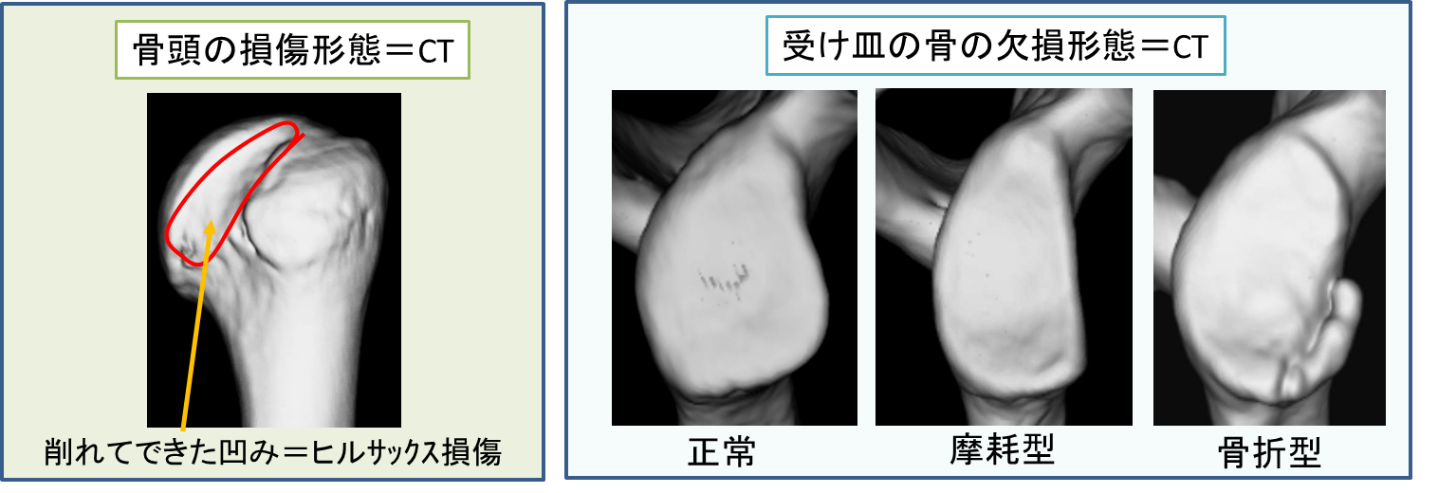 肩の脱臼のCT画像