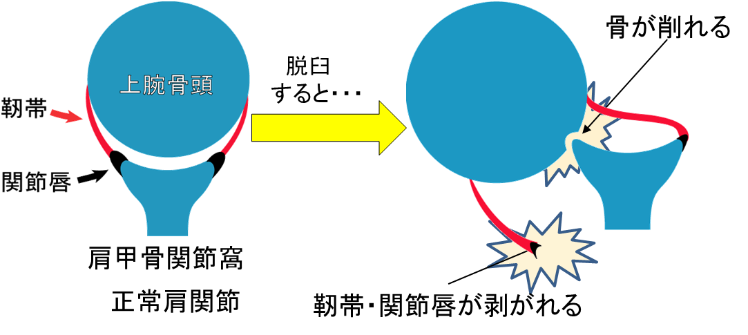 肩の脱臼イメージ