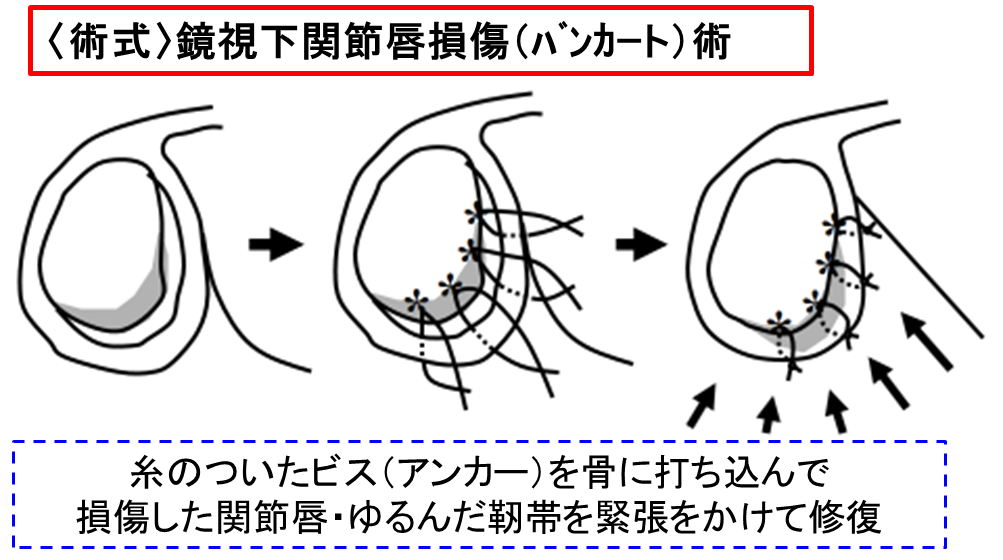 鏡視下バンカート修復術