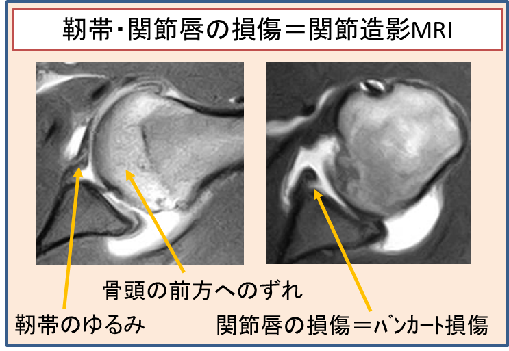 肩の脱臼画像のMRI