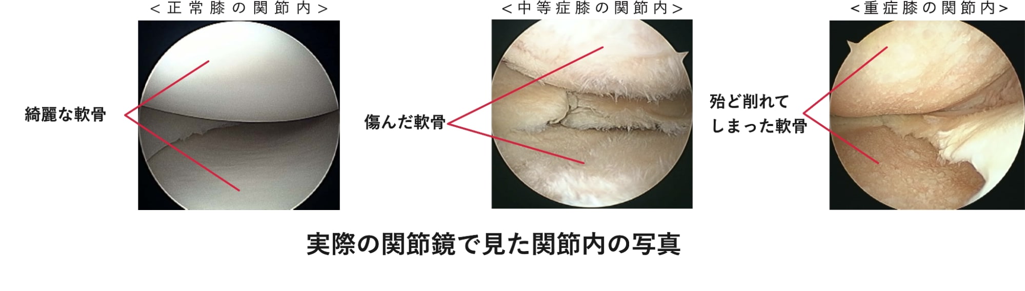 実際の関節鏡で見た膝の中