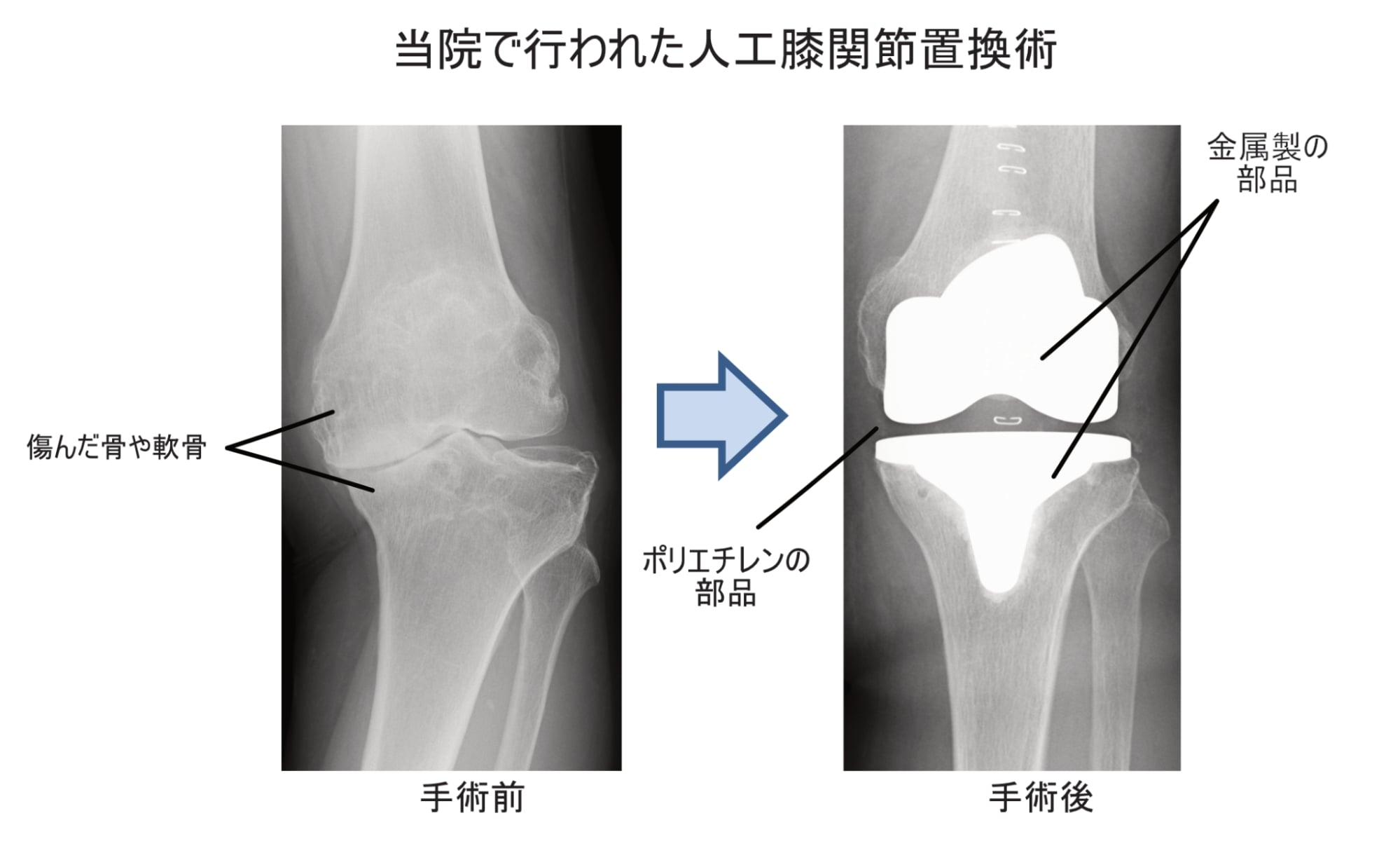 当院で行われた人工膝関節置換術