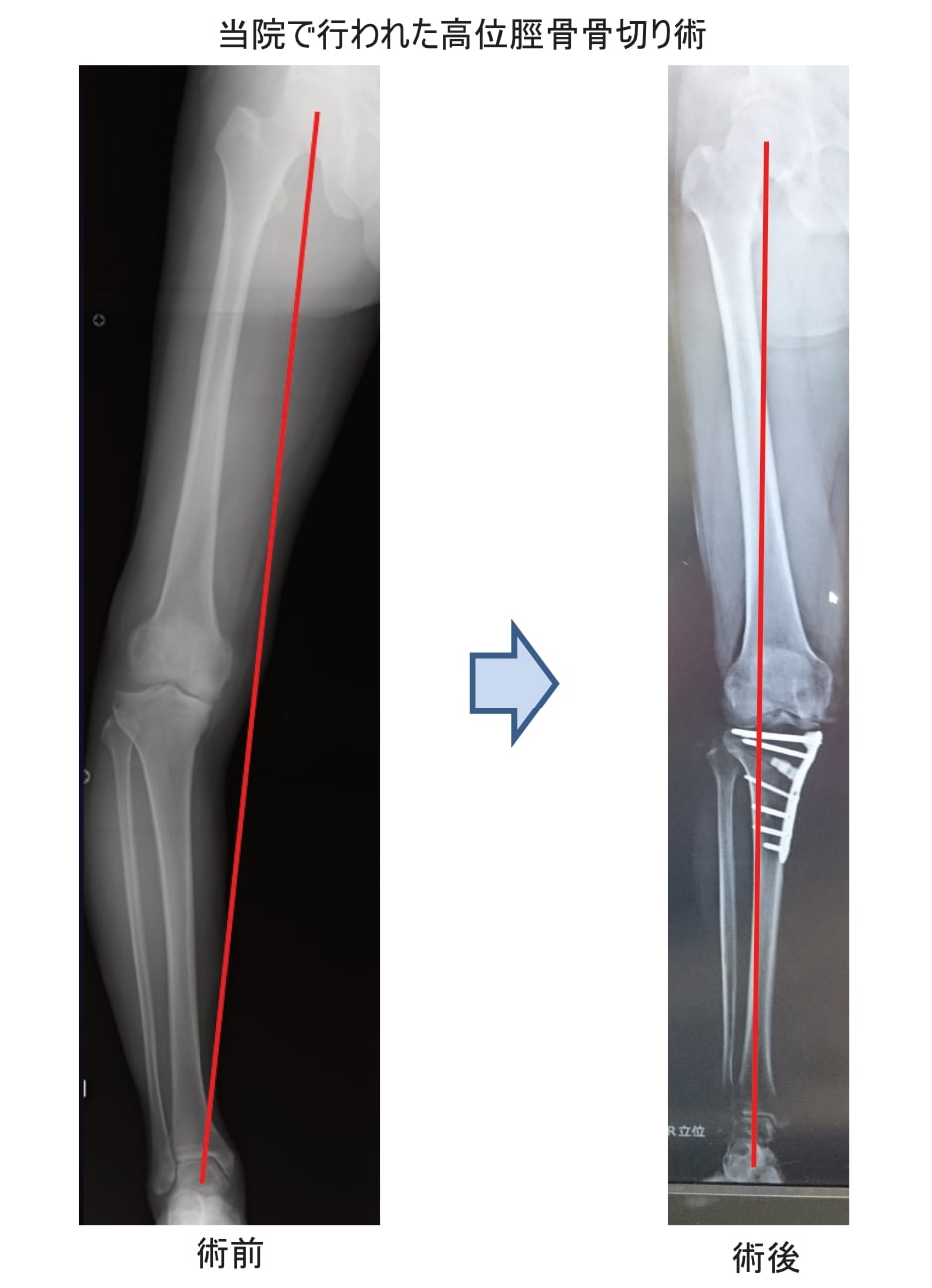 高位脛骨骨切り術