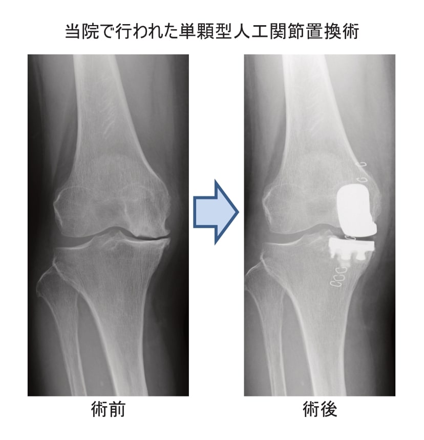 当院で行った人工膝関節単顆置換術