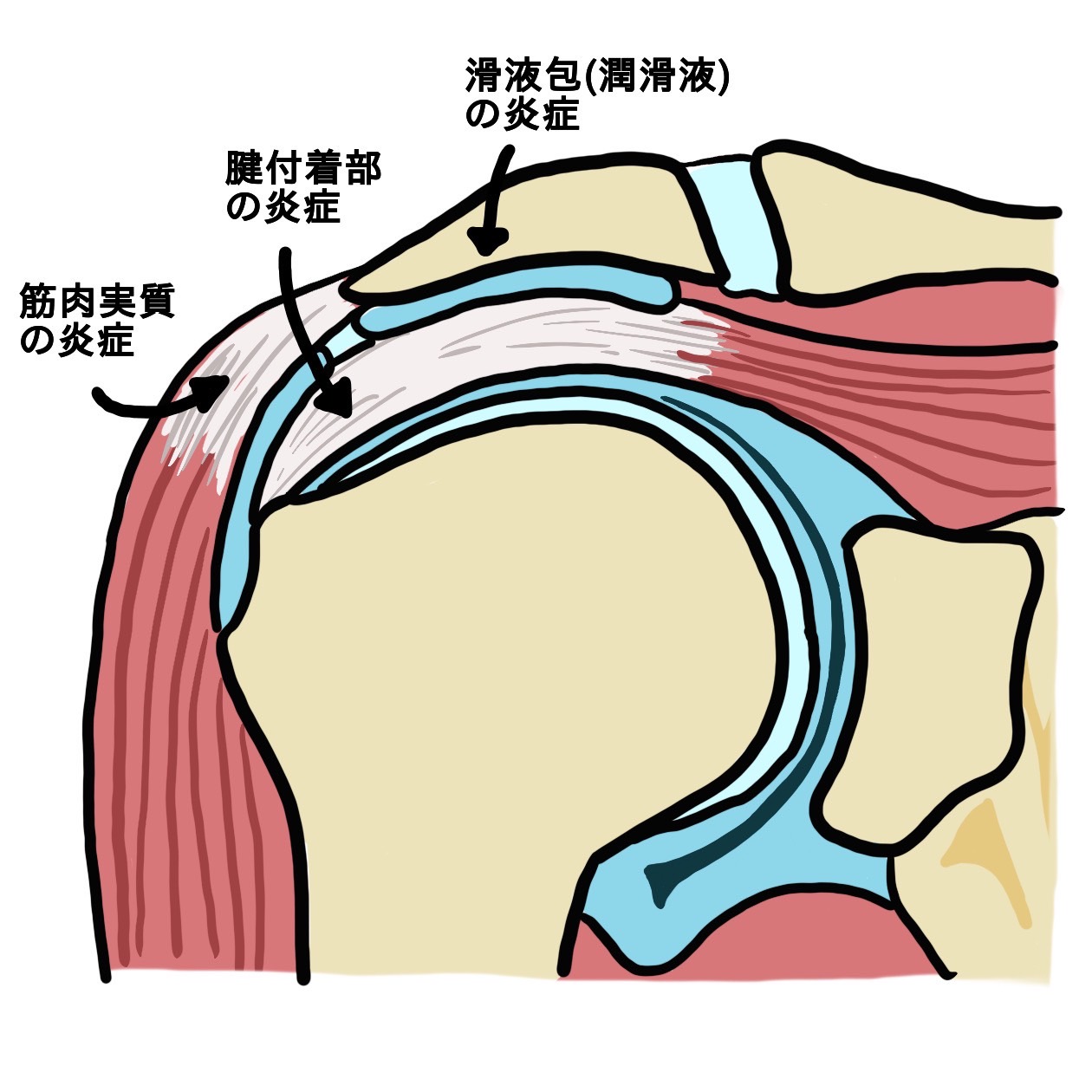 肩 が 腫れる