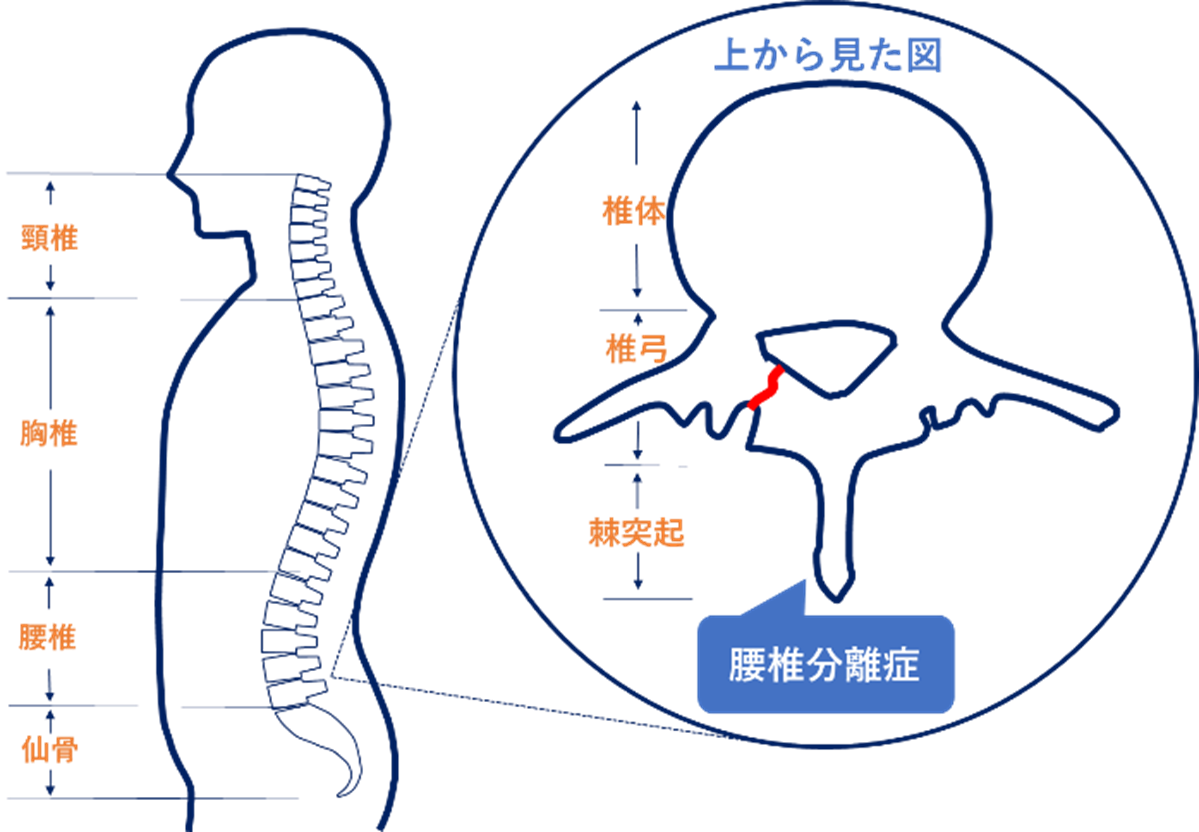 腰椎分離症