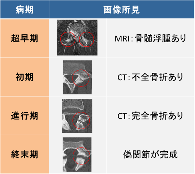 腰椎分離症_進行度