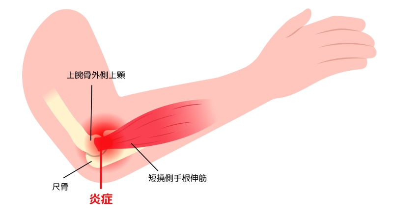 上腕骨外側上顆炎の病態