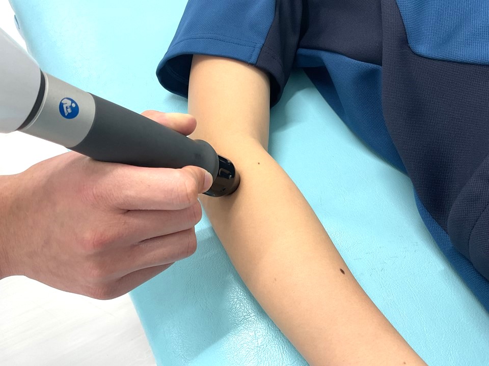 写真9拡散型圧力波の治療例②