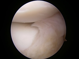 腕橈関節の滑膜ヒダ