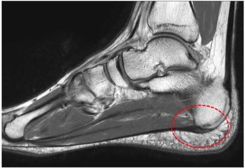足底腱膜の変性が見られるMRI画像