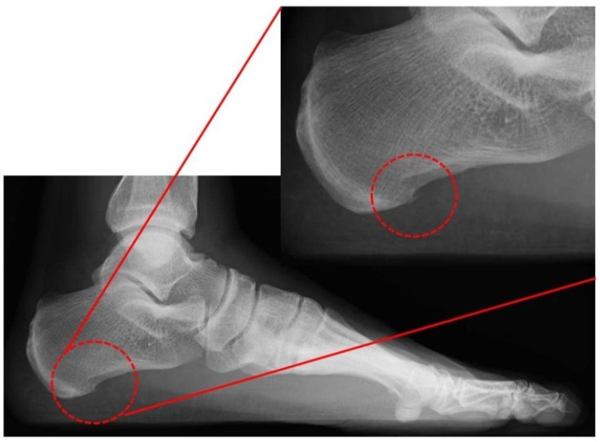 踵の骨(踵骨)に骨のトゲ(骨棘)が見られるレントゲン画像