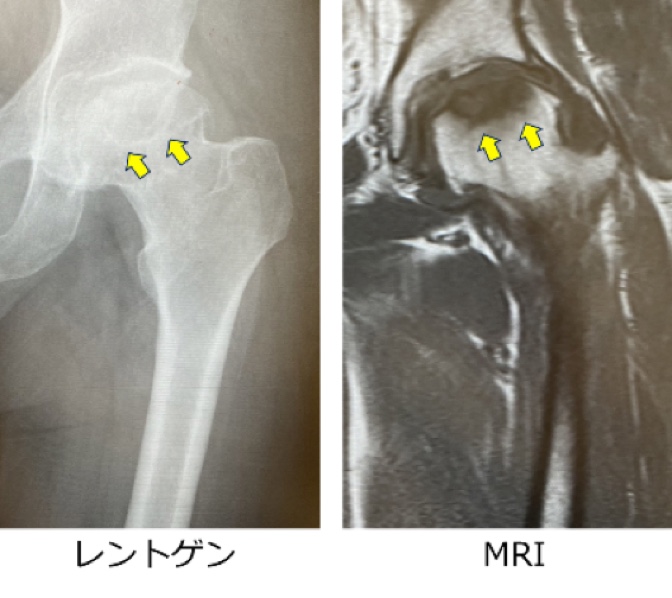 臼 蓋 形成 不全 やってはいけない こと