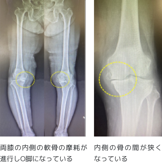 変形 性 膝 関節 症