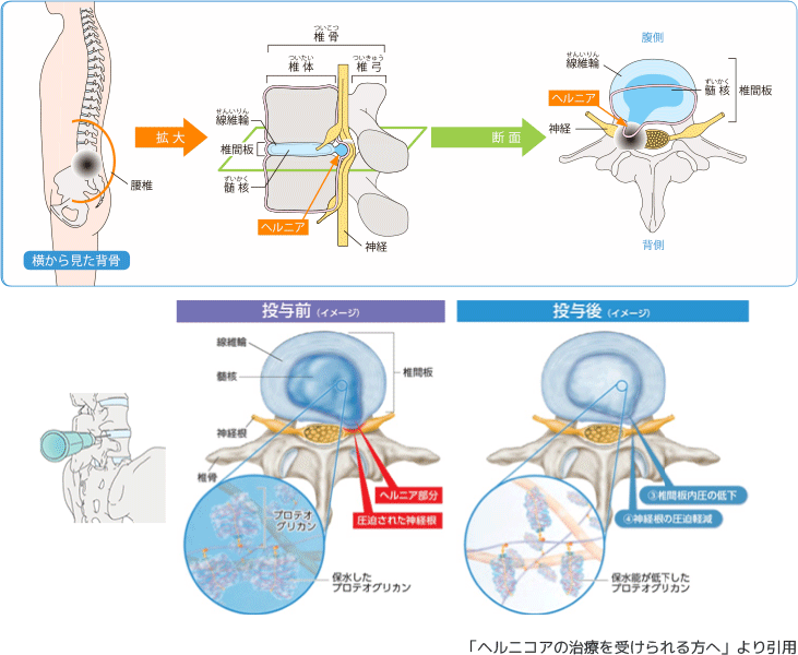 椎間板 ヘルニア 治療